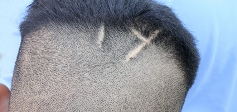 Hair Transplant On Scar | Does Hair Transplant Work on Scars | Can I Get a Hair Transplant On a Scar?