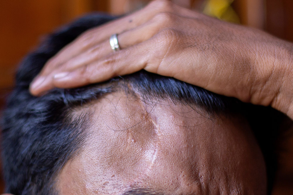 Hair Transplant On Scar | Does Hair Transplant Work on Scars | Can I Get a Hair Transplant On a Scar?